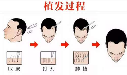 FUE植发技术的术后护理与注意事项
