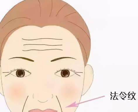 自体脂肪填充法令纹有效吗?能持续多久?