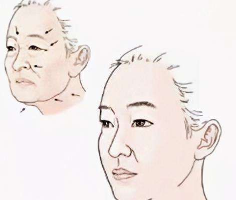 电波拉皮和超声刀有什么区别