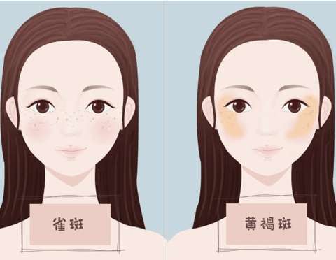 黄褐斑1.jpg