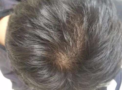 戒色两个月，头顶头发彻底恢复：一个改变人生的历程