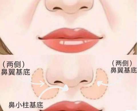 鼻基凹陷1.jpg