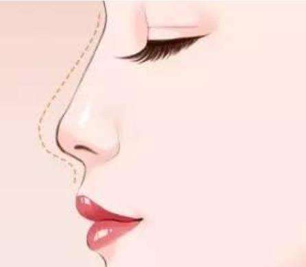 线雕隆鼻1.jpg