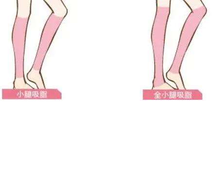 小腿吸脂.jpg