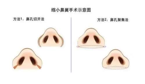 缩小鼻翼.jpg