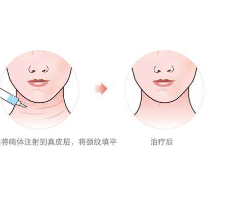 嗨体去除颈纹1.jpg