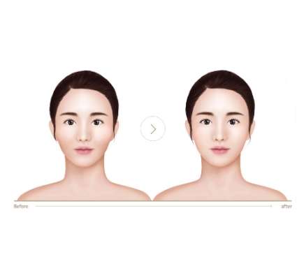 颧骨缩小术1.jpg