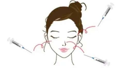 什么是太阳穴，哪些情况可以丰太阳穴