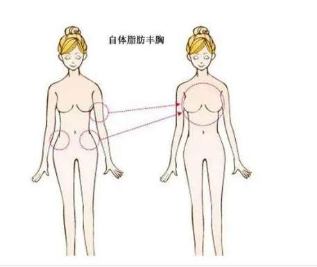 自体脂肪丰胸1.jpg