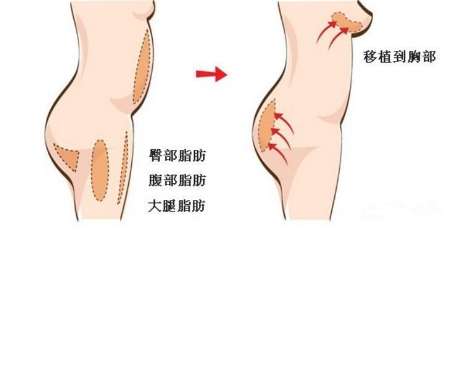 自体脂肪丰胸2.jpg