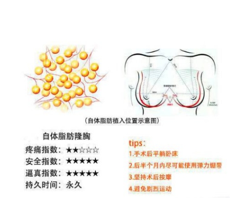 自体脂肪丰胸3.png