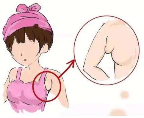 副乳切除1.jpg