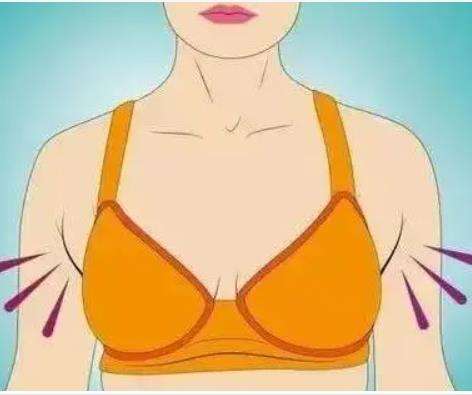 副乳切除.jpg