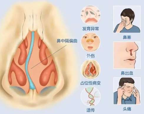 鼻中隔偏曲1.jpg