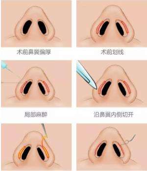 鼻头缩小.jpg