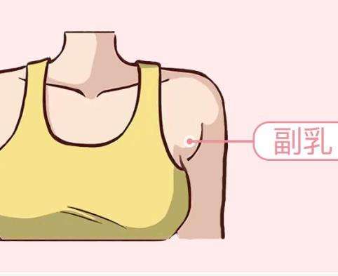 副乳切除术4.jpg