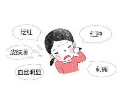 激光去除红血丝6.jpg
