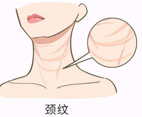 颈部除皱术2.jpg