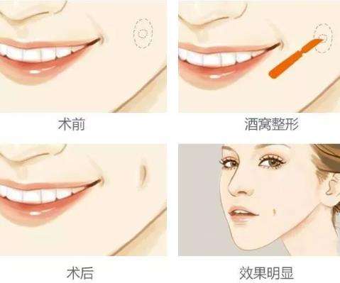 人造酒窝的方法有哪些?.jpg