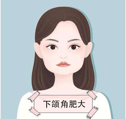 下颌角肥大矫正.jpg