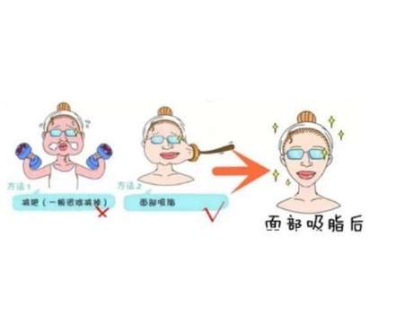 面部吸脂4.jpg