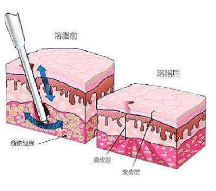 深蓝射频溶脂有效吗，有哪些优势