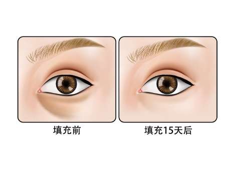 自体脂肪填充泪沟1.jpg