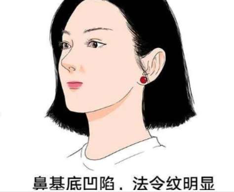 鼻基凹陷.jpg