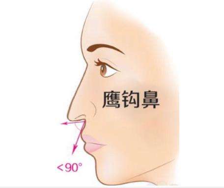 鹰钩鼻矫正.jpg