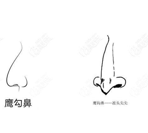 鹰钩鼻矫正1.jpg