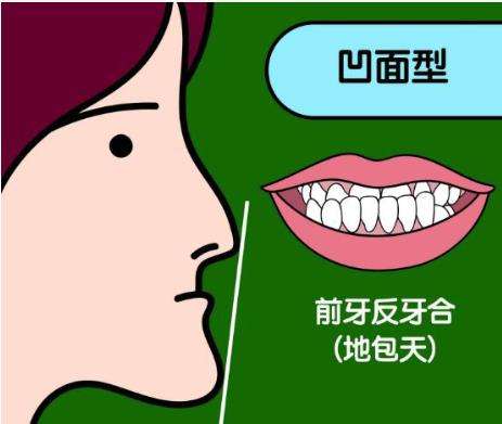 地包天矫正.jpg
