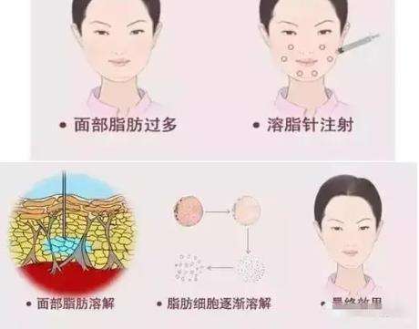 面部吸脂的效果可以永久吗?