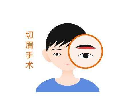切眉手术1.jpg