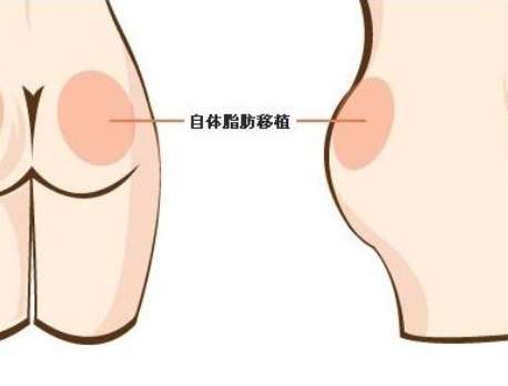 自体脂肪丰臀.jpg